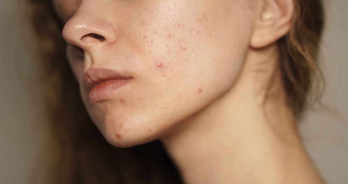 mulher branca mostrando suas lesões de acne no rosto